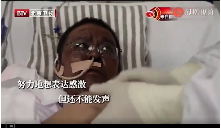 Wuhan doctors wake from fighting virus to find skin has changed colour